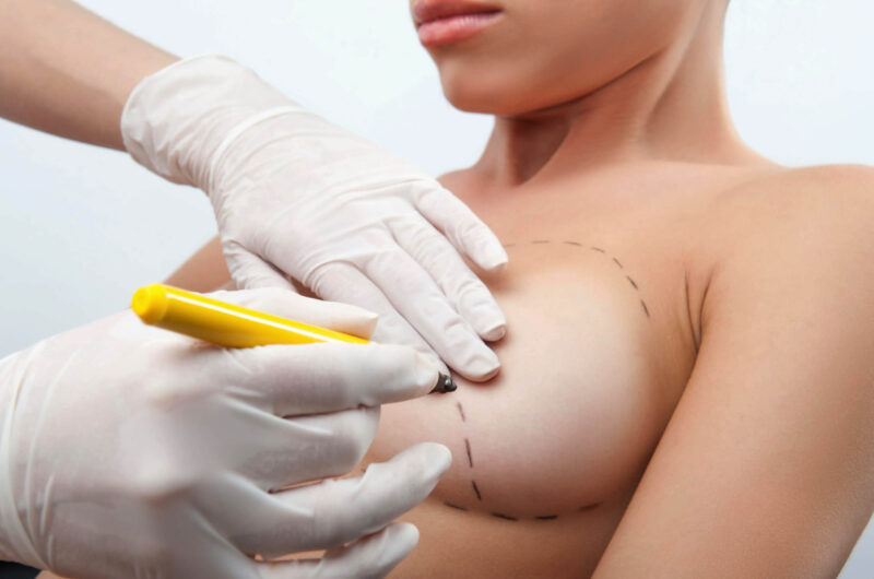 Breast Augmentation: Your Complete Guide to Enhancing Your Bust