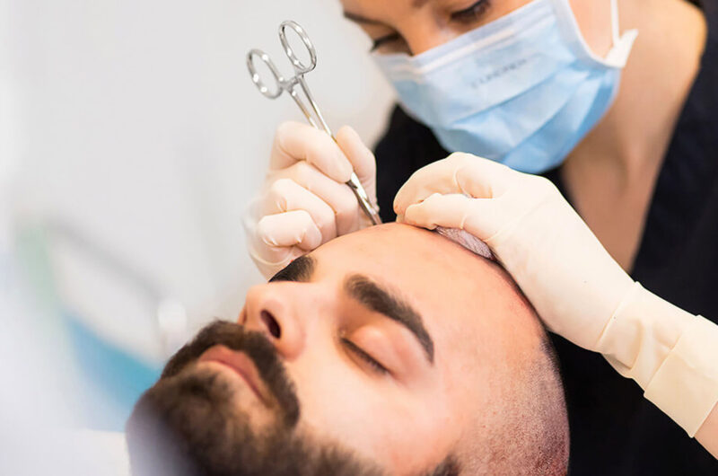 Hair Transplant: Comprehensive Guide to Procedures, Care, and Recovery